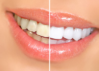 Teeth Whitening | Dentist in Kansas City, MO | Dr. Todd Bellem